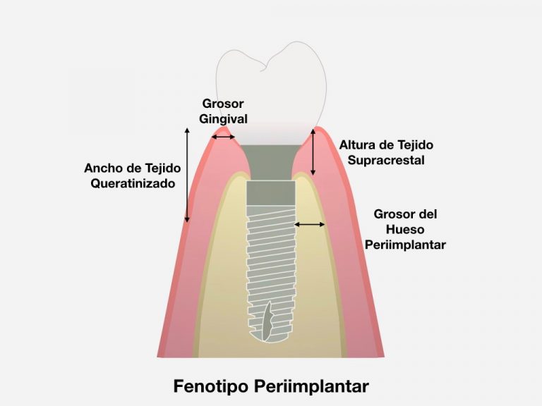 Importancia del Fenotipo Periimplantar en el Éxito de los Implantes Dentales