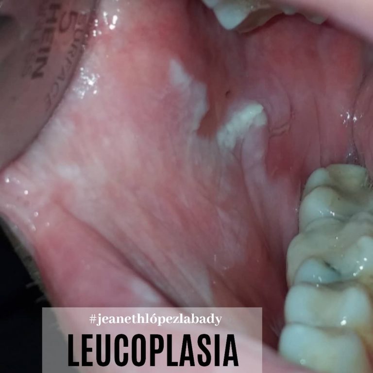 Candida como factor de riesgo de la leucoplasia oral
