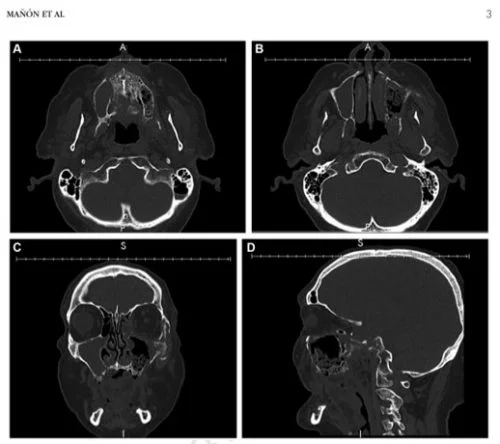 Imágenes de tomografías computarizadas de cabeza y mandíbula en estudios odontológicos y maxilofaciales, resaltando diagnóstico y planificación en odontología.