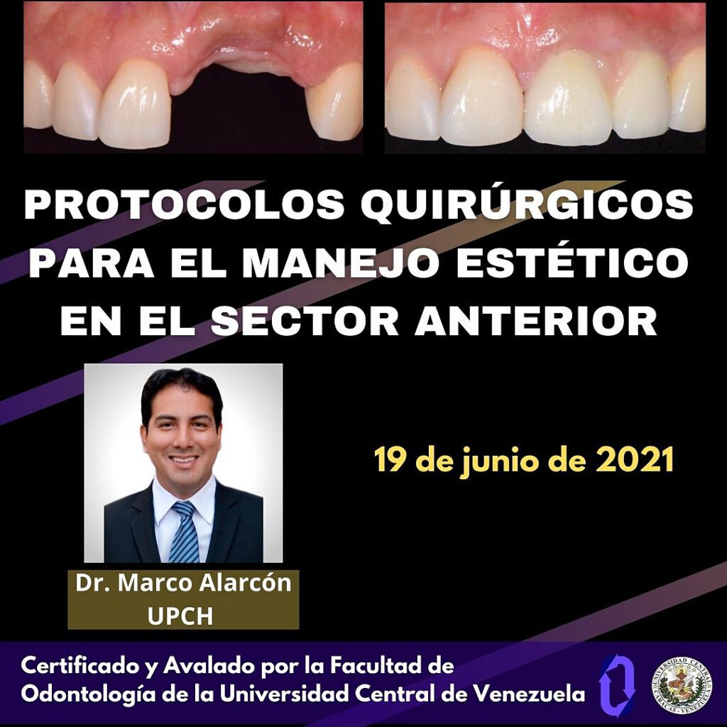 Cierre de espacios interdentales con carillas dentales en anterior superior, tratamiento estético en odontología.