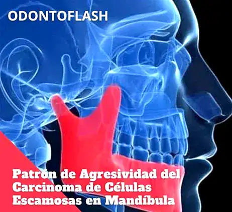 Patrón de agresividad del carcinoma de células escamosas en mandíbula, imagen médica y odontológica avanzada.