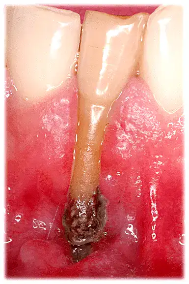 Extracción de un conducto radicular con presencia de caries y infección en la raíz.