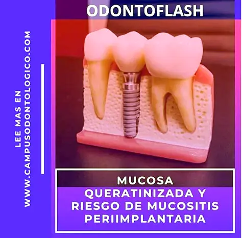 Modelación de un implante dental en encía con restauración de coronas.