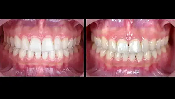 Dientes alineados y blancos tras tratamiento ortodóntico en clínica dental especializada.