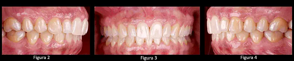 Dientes mal alineados y problemas de mordida, tratamiento ortodóntico para corregir la maloclusión.