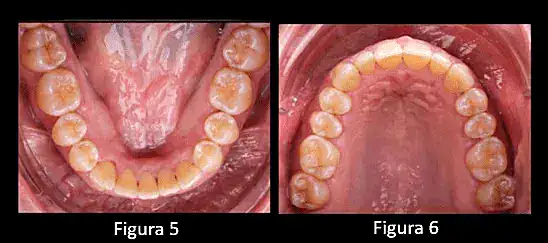 Dientes inferiores y superiores con alineación dental y ortodoncia, imagen clínica de tratamiento dental en la clínica odontológica.