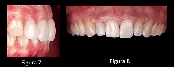 Dentadura saludable, tratamiento odontológico preventing y estética dental, en campusodontologico.com.