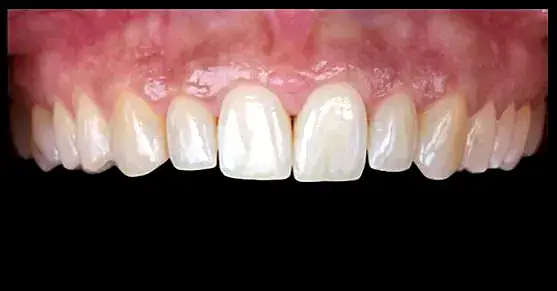 Dientes desgastados y daño en la dentina debido a caries o bruxismo en paciente dental.