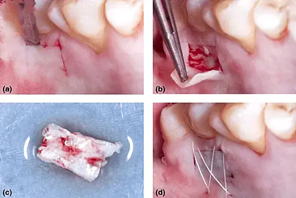 Archivo de imagen de procedimientos odontológicos quirúrgicos en la encía y hueso maxilar.