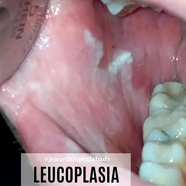 Tejido bucal afectado por leucoplasia, condición premaligna en la mucosa oral.