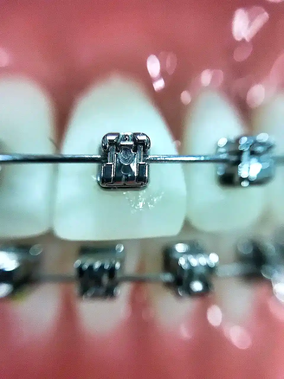 Arnés ortodóntico con brackets en dientes superiores, close-up de tratamiento de ortodoncia en clínica odontológica, reparación y alineación dental.