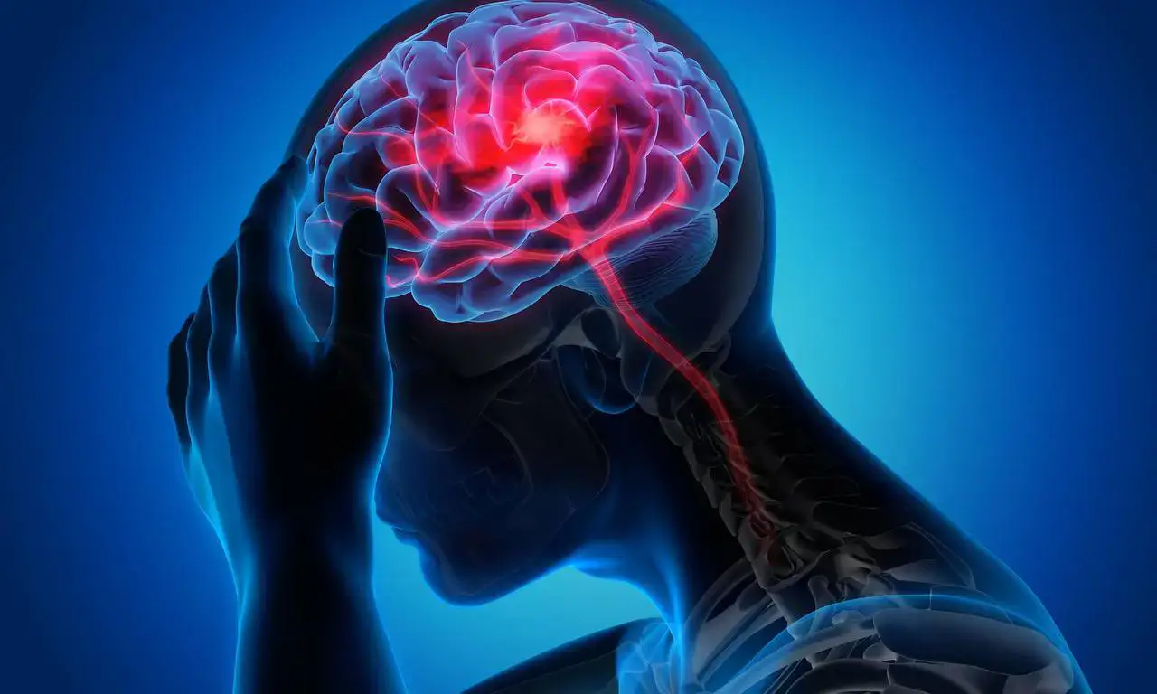 Ilustración de un cerebro con dolor de cabeza, relacionado con cefaleas en odontología, en un contexto médico y dental.